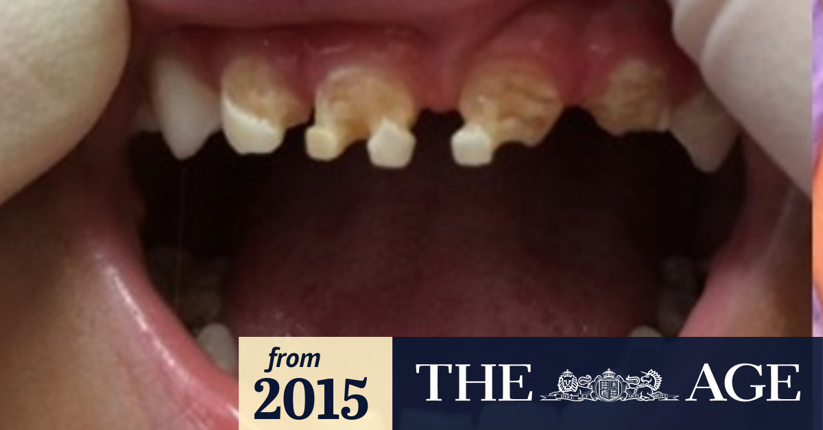 Kids as young as 18 months needing rotten teeth pulled because of bad decay
